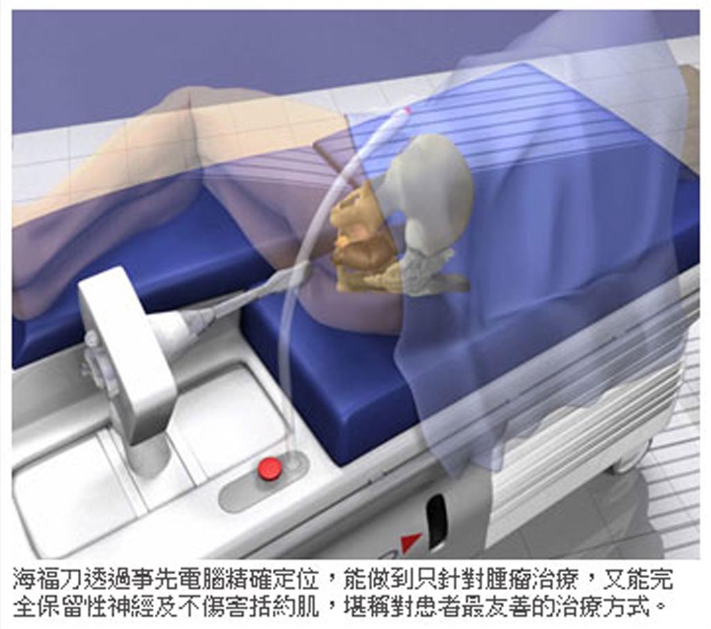 海扶刀從肛門進入治療攝護腺腫瘤