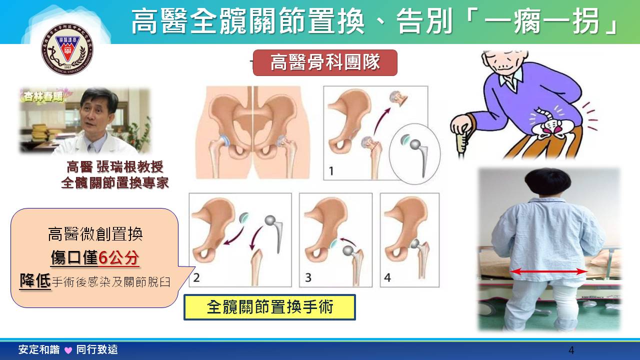 關節置換療